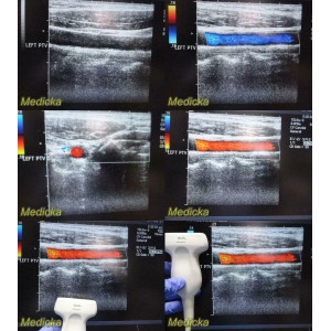 https://www.themedicka.com/10060-111672-thickbox/siemens-acuson-15l8w-linear-array-ultrasound-transducer-probe-08241113-24845.jpg