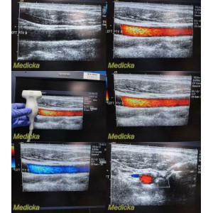 https://www.themedicka.com/10143-112632-thickbox/acuson-model-15l8w-linear-array-ultrasound-transducer-probe-24864.jpg