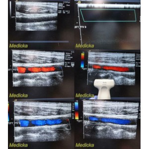 https://www.themedicka.com/10144-112644-thickbox/siemens-acuson-08241113-15l8w-linear-array-ultrasound-transducer-probe-24894.jpg