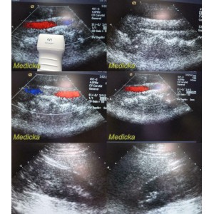 https://www.themedicka.com/10192-113210-thickbox/2009-acuson-4v1-model-08257869-vector-array-ultrasound-transducer-probe-24801.jpg