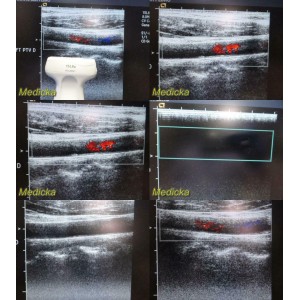 https://www.themedicka.com/10219-113503-thickbox/2006-acuson-15l8w-linear-array-ultrasound-transducer-probe-24831.jpg