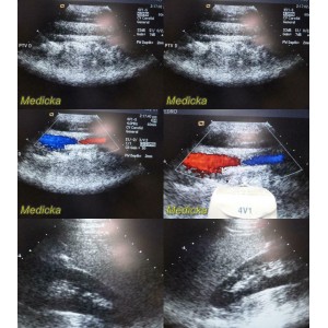 https://www.themedicka.com/10224-113563-thickbox/acuson-siemens-4v1-sector-array-ultrasound-transducer-probe-08252072-24825.jpg