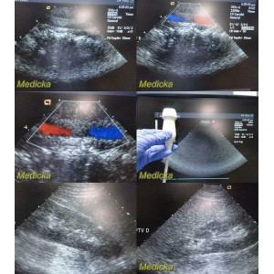 https://www.themedicka.com/10243-113791-thickbox/acuson-3v2c-vector-array-ultrasound-transducer-probe-24754.jpg