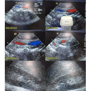 https://www.themedicka.com/10245-113815-thickbox/acuson-3v2c-phased-array-ultrasound-transducer-probe-24750.jpg