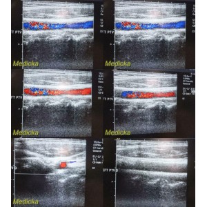 https://www.themedicka.com/10253-113911-thickbox/2005-acuson-15l8w-linear-array-ultrasound-transducer-probe-24767.jpg