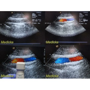 https://www.themedicka.com/10259-113983-thickbox/acuson-8v5-sector-array-ultrasound-transducer-probe-24756.jpg