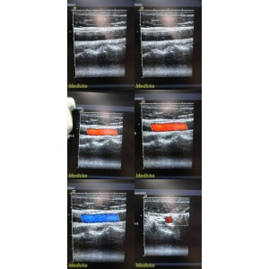 https://www.themedicka.com/11926-132956-thickbox/siemens-acuson-6l3-la-linear-array-ultrasound-transducer-model-08241112-25718.jpg