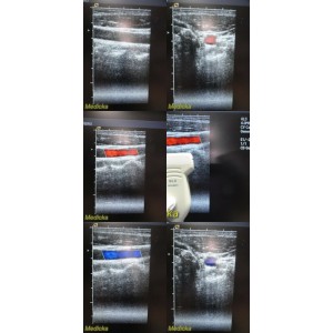 https://www.themedicka.com/11930-133004-thickbox/siemens-medical-acuson-6l3-linear-array-ultrasound-probe-ref-08241112-25713.jpg