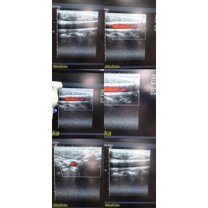 https://www.themedicka.com/14913-167386-thickbox/acuson-15l8w-linear-array-ultrasound-transducer-probe-23954.jpg